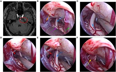 Case report: Fully endoscopic microvascular decompression for trigeminal neuralgia